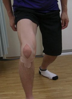 ジャンパー膝（膝蓋靱帯炎）